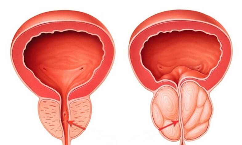 Healthy and inflammatory prostate with prostatitis